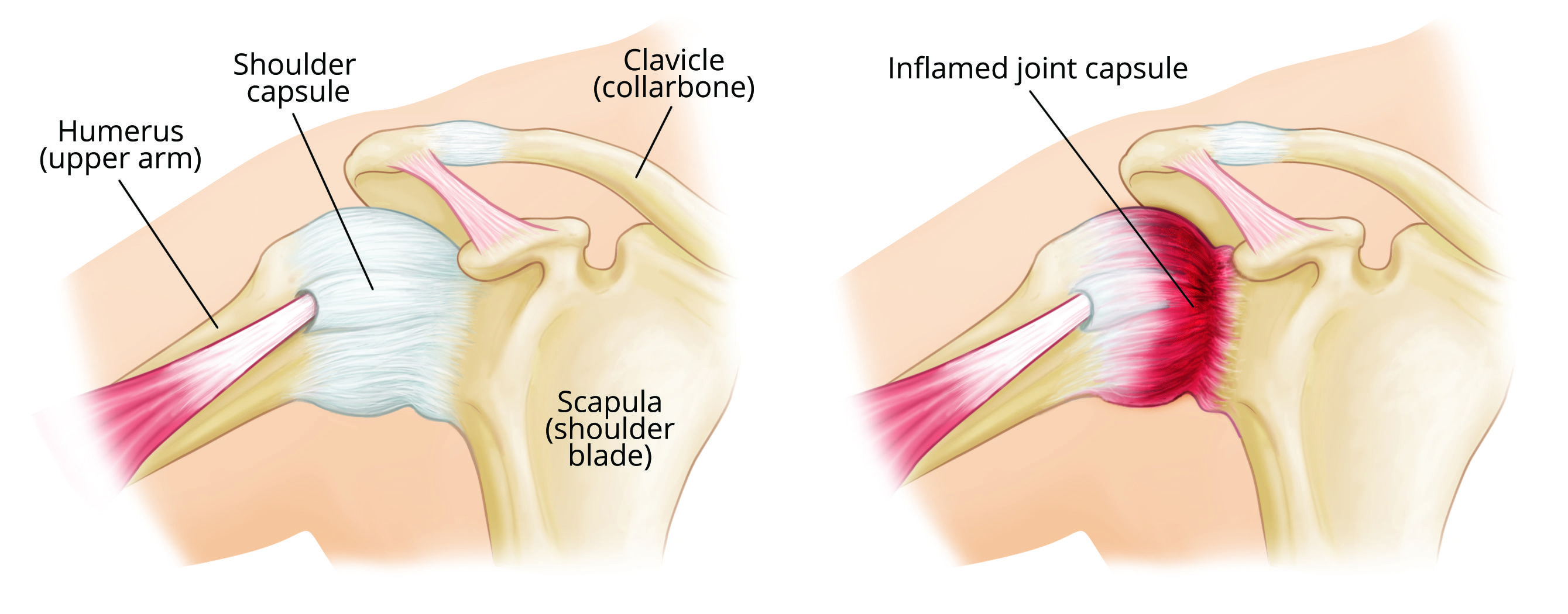 Frozen shoulder anatomy showing stiff joint capsule